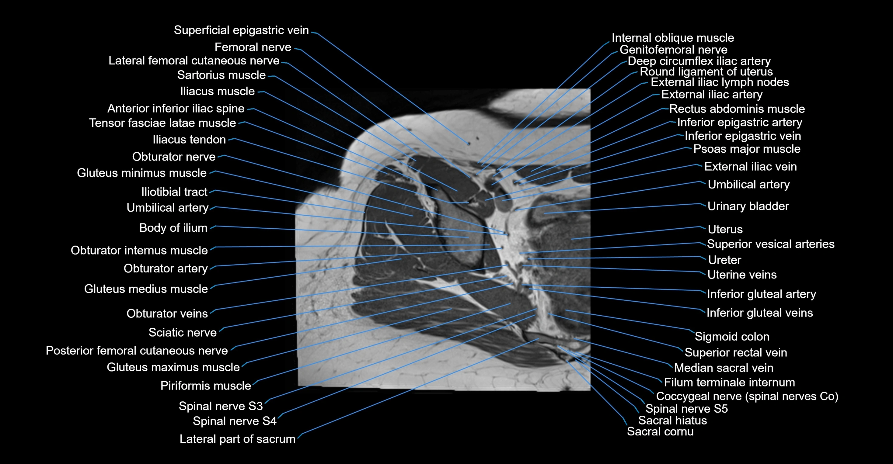 MRI hip axial cross sectional anatomy 3T 3D  radiology  anatomy image-img-00001-00021.webp